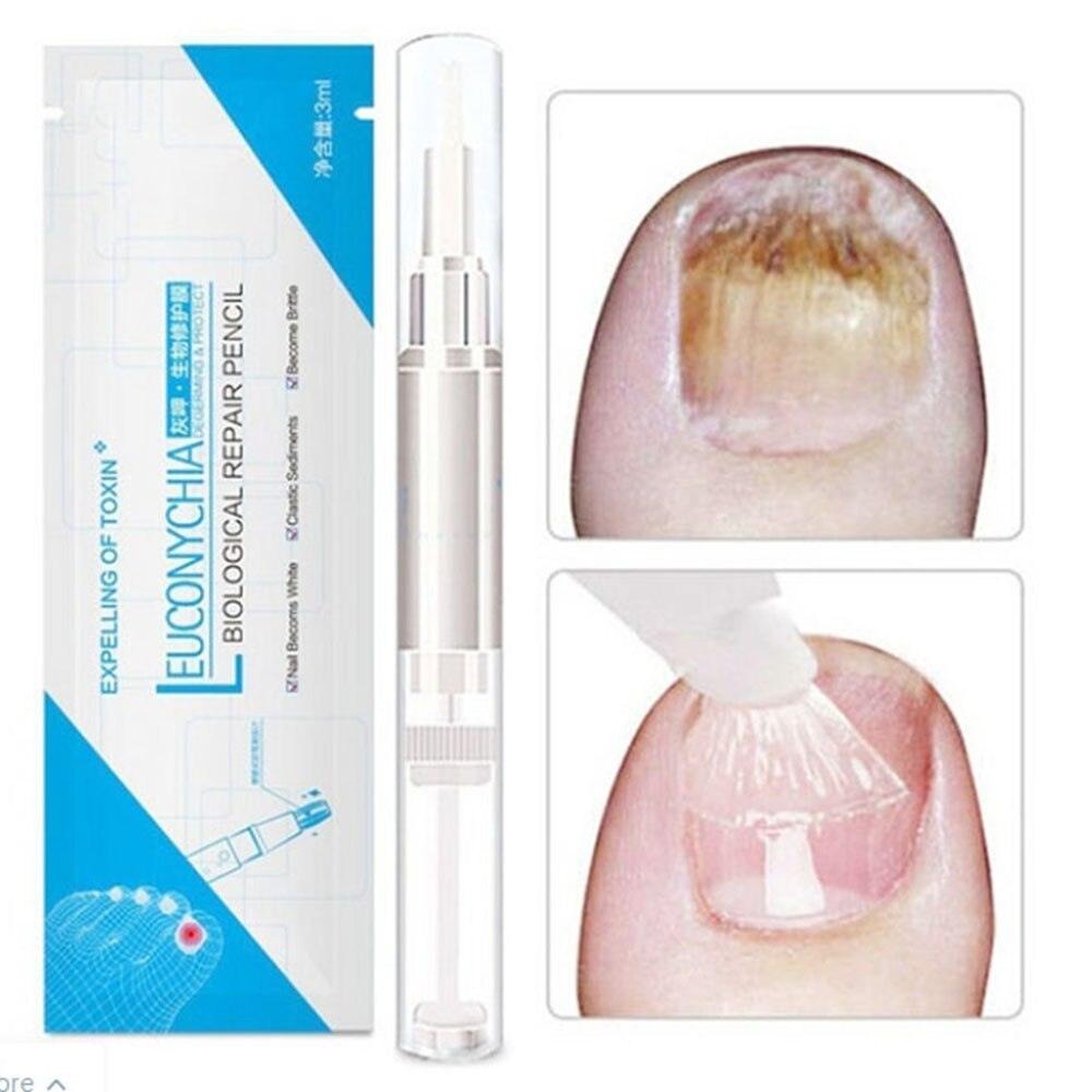 4pc 3ml Anti Fungal Treatment Cuticle Oil Pen Nail Repair Pen Onychomycosis  Infection | Fruugo BH