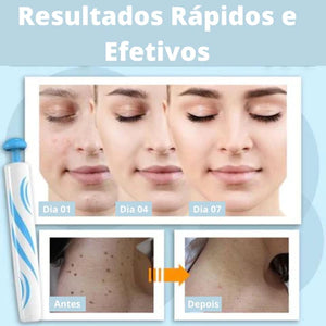 REMOVER PRO MAX® - Removedor de Verrugas (Promoção Relâmpago: 40% OFF SÓ HOJE!)