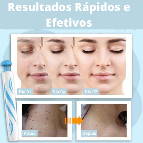 REMOVER PRO MAX® - Removedor de Verrugas (Promoção Relâmpago: 40% OFF SÓ HOJE!)