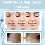 REMOVER PRO MAX® - Removedor de Verrugas (Promoção Relâmpago: 40% OFF SÓ HOJE!)