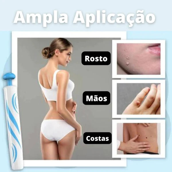 REMOVER PRO MAX® - Removedor de Verrugas (Promoção Relâmpago: 40% OFF SÓ HOJE!)