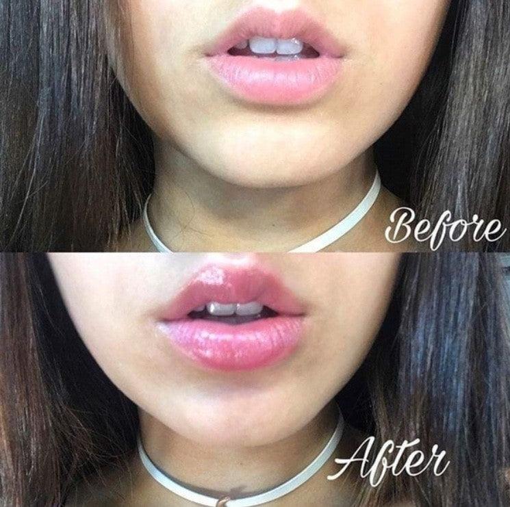 Lip Plump Soft® - Essential Store